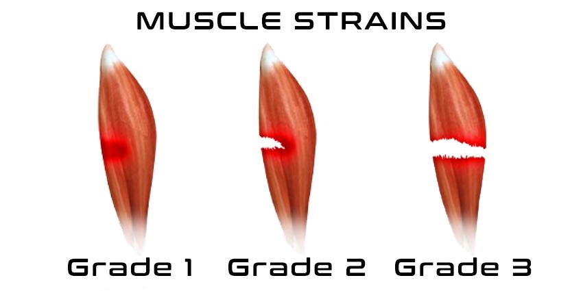 Muscle Injuries & Strains