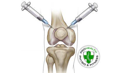 Corticosteroid or Cortisone Injections