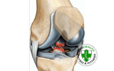 Do I need surgery after rupturing my ACL?